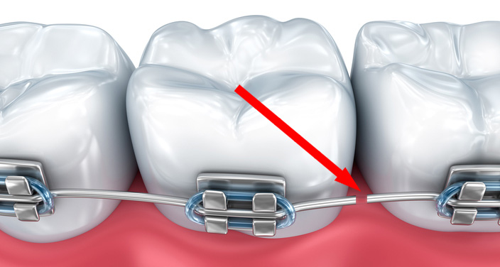 What to do if My Braces Wire Pokes Me?